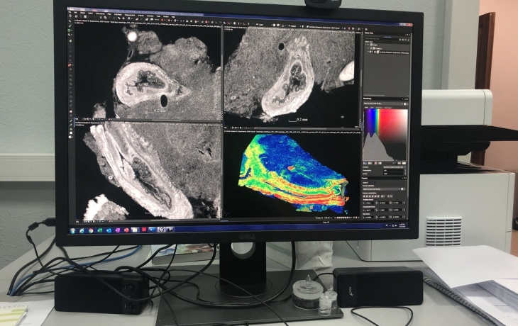 Рак распространяется как сеть: российские ученые наблюдали в 3D особенности развития опухолей