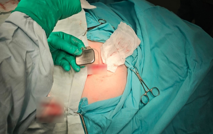 В Нижнем Новгороде пациенту с эпилепсией поставили «нейростимулятор нового поколения»